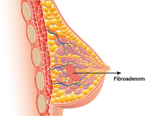 Fibroadenomlar kansere dönüşür mü?