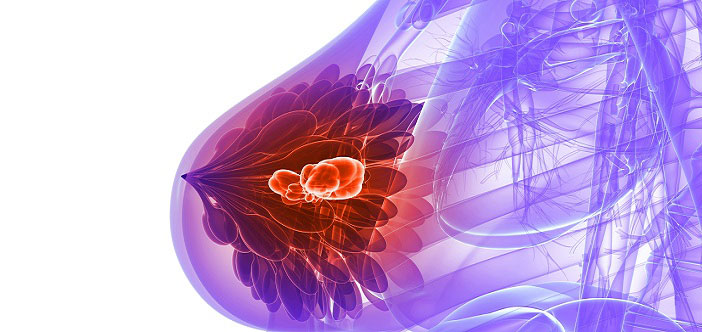 Memenin iyi huylu tümörleri (fibroadenomlar) nasıl tedavi edilir?